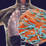 Tuberculosis: Plateau