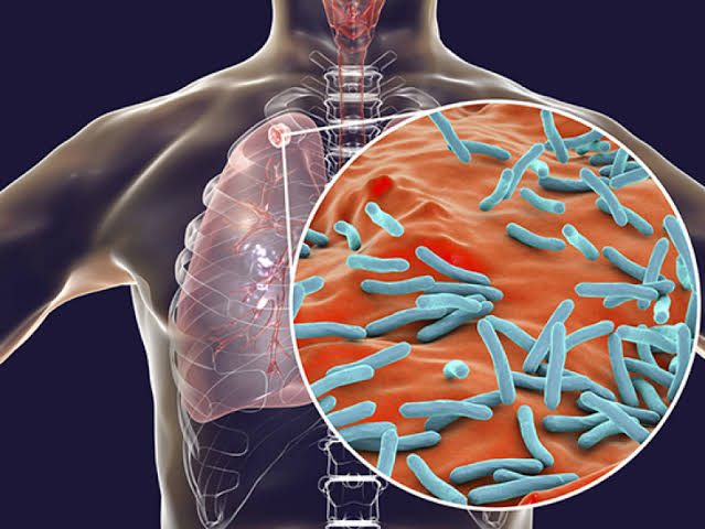 Tuberculosis: Plateau