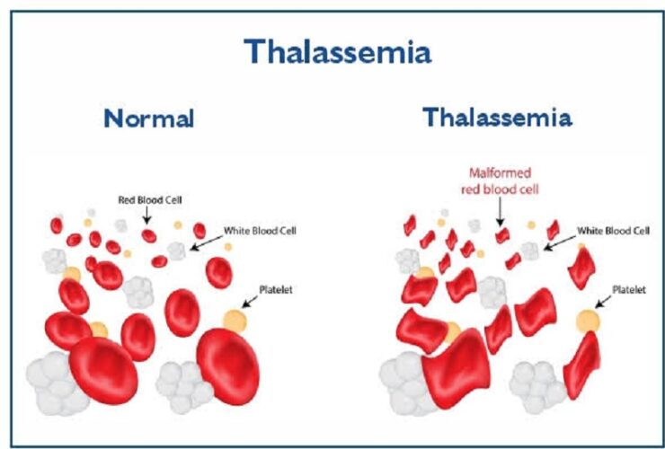 Over 32K Thalassemia cases detected in Egypt