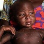 Suspected measles outbreak kills 10 children in Nigeria's capital Abuja