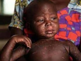 Suspected measles outbreak kills 10 children in Nigeria's capital Abuja