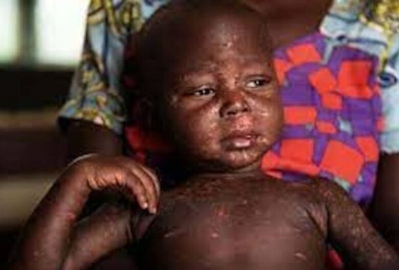 Suspected measles outbreak kills 10 children in Nigeria's capital Abuja