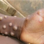 ECOWAS raises alarm as Mpox spreads in Africa