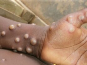 ECOWAS raises alarm as Mpox spreads in Africa