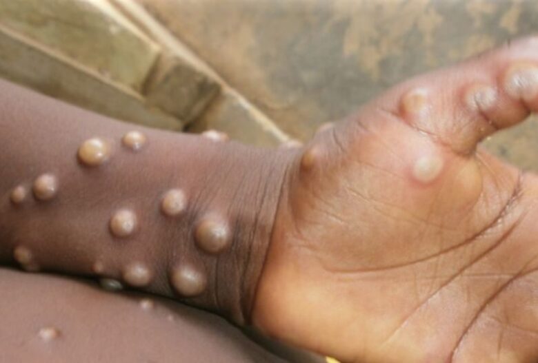 ECOWAS raises alarm as Mpox spreads in Africa