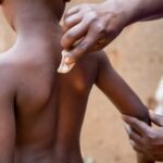 DRC faces crisis as Mpox