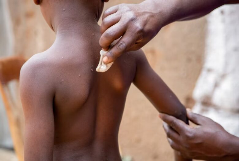 DRC faces crisis as Mpox