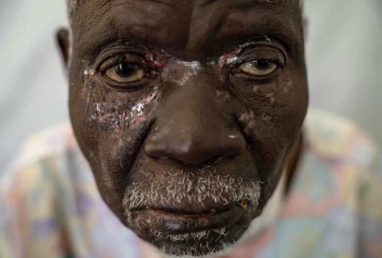 Africa reports nearly 30000 suspected Mpox cases in 2024 primarily in DR Congo WHO says